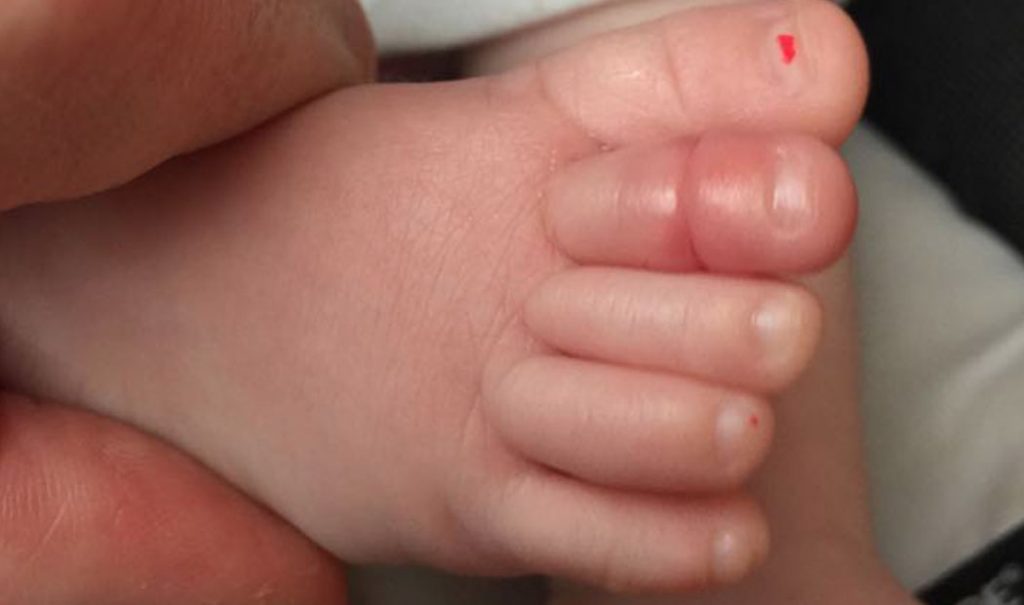 Síndrome del torniquete: riesgo de amputación de los dedos del bebé